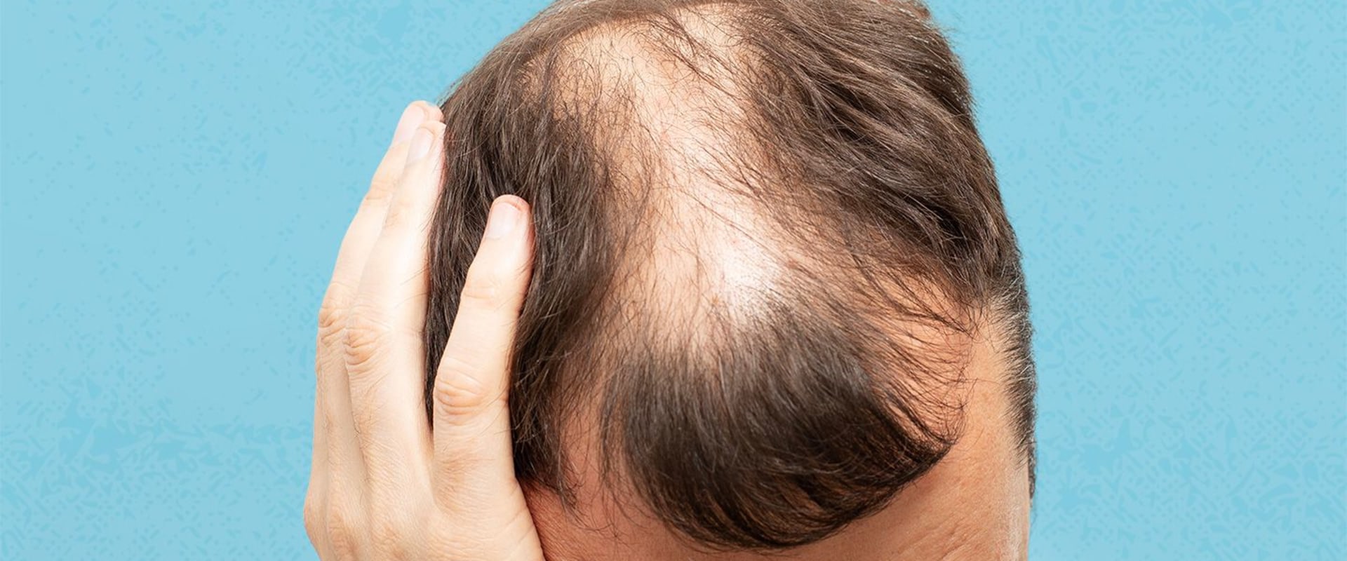 Hormonal Changes and Female Hair Loss: Causes and Risk Factors