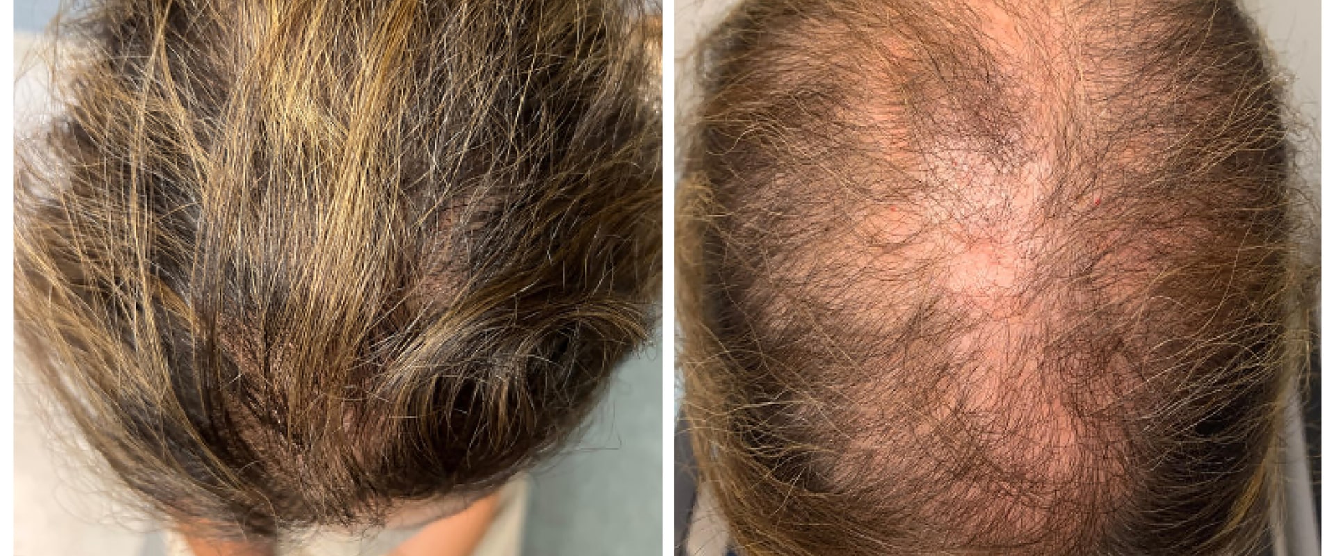 Medical Treatments for Female Hair Loss