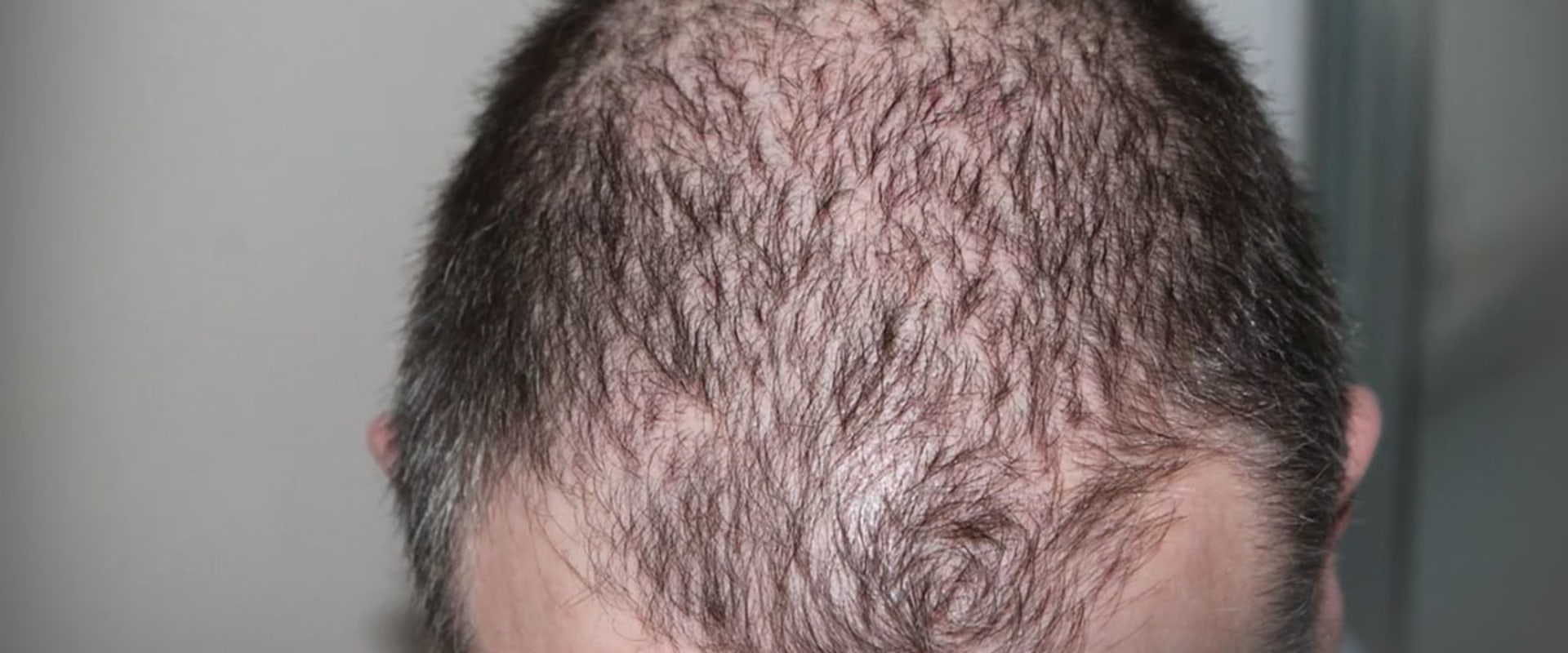 Iron-Deficiency Anemia and Hair Loss: A Comprehensive Overview