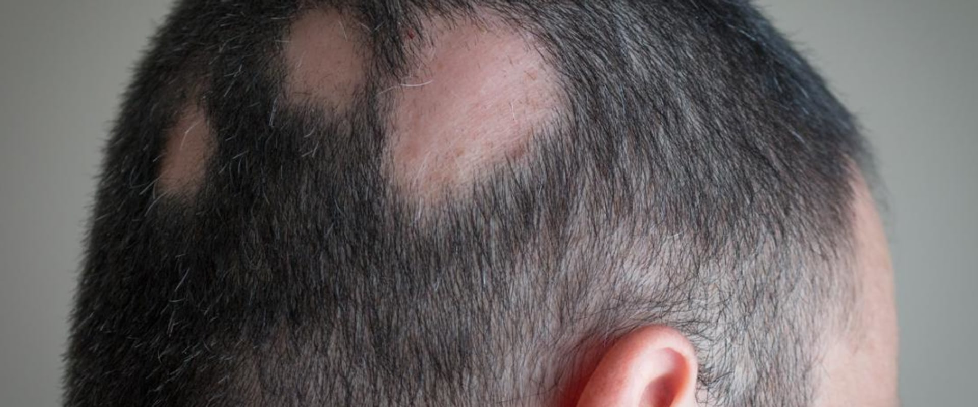 Alopecia: Causes, Symptoms, and Treatment