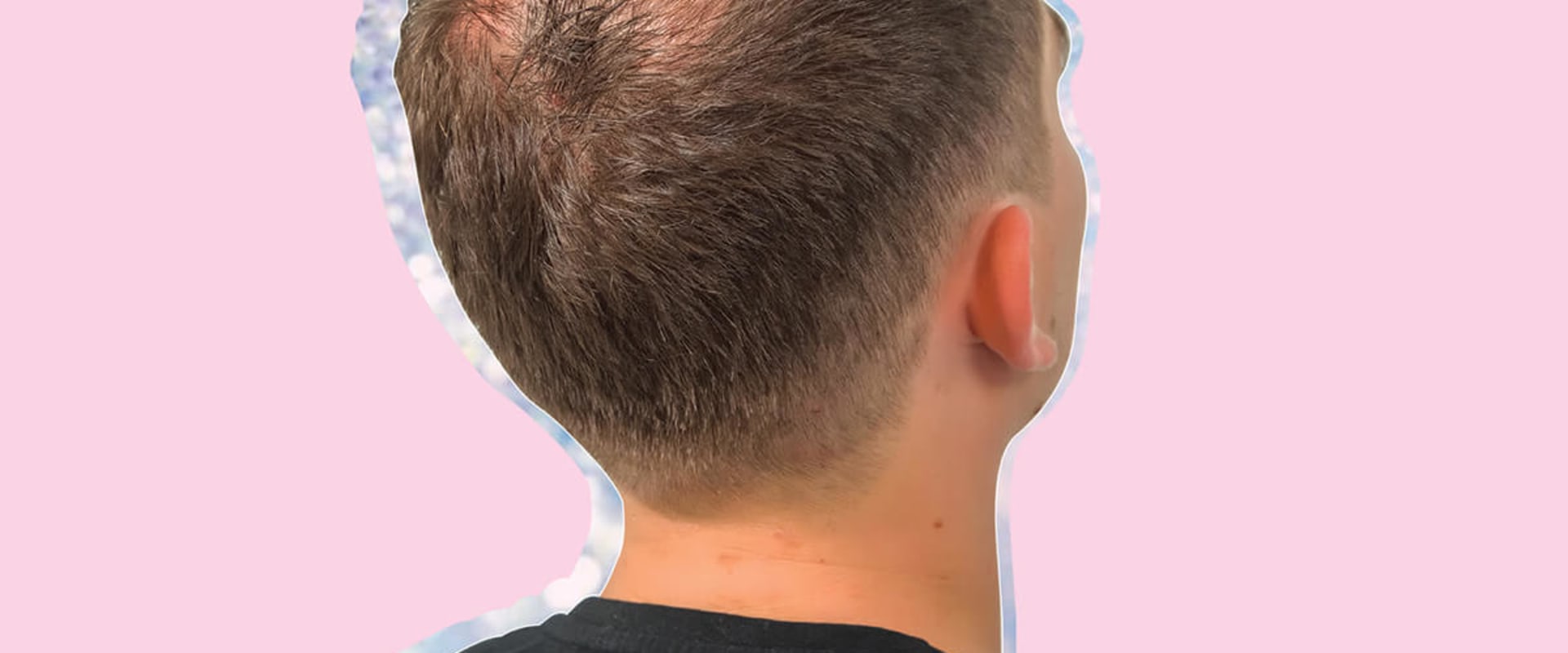 Male Pattern Baldness: Hormonal Changes and Their Impact