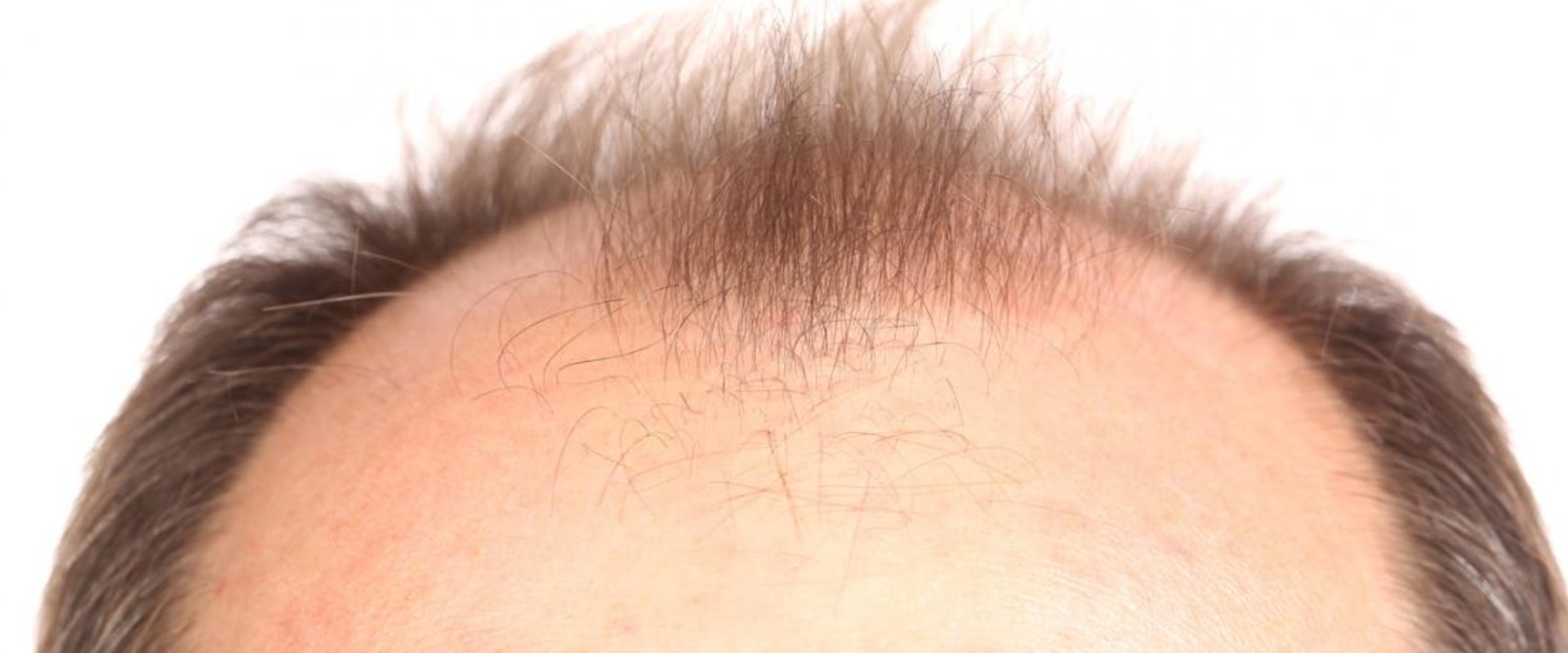 Medical Treatments for Male Pattern Baldness