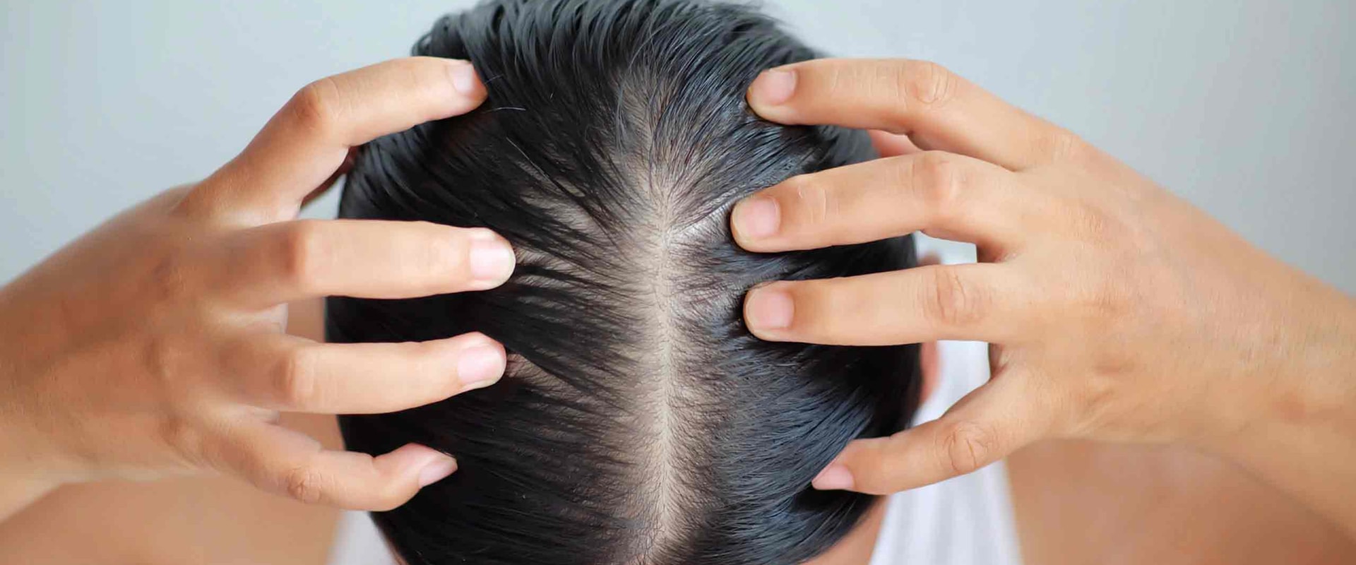 Understanding Hormonal Imbalances and Hair Loss