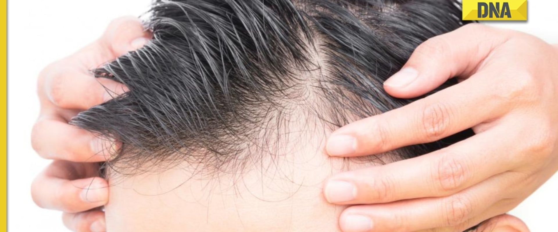 Male Pattern Baldness: Causes, Symptoms, and Treatments