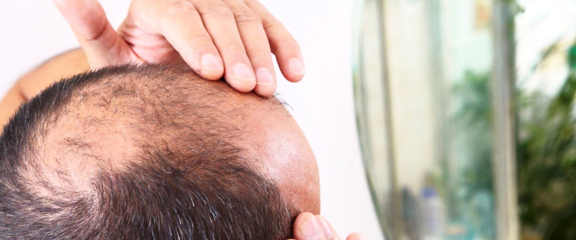 Lifestyle Factors and Male Pattern Baldness