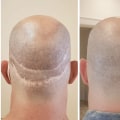 Exploring Scalp Camouflage Techniques for Hair Loss Solutions
