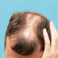 Hormonal Changes and Female Hair Loss: Causes and Risk Factors
