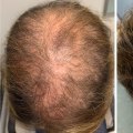 Medical Treatments for Female Hair Loss