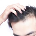 Vitamin D for Hair Growth