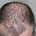 Iron-Deficiency Anemia and Hair Loss: A Comprehensive Overview