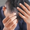 The Link Between Stress and Hair Loss