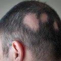 Alopecia: Causes, Symptoms, and Treatment