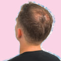 Male Pattern Baldness: Hormonal Changes and Their Impact