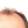Medical Treatments for Male Pattern Baldness