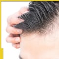 Male Pattern Baldness: Causes, Symptoms, and Treatments