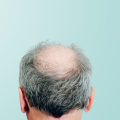 Hereditary Hair Loss: Exploring the Causes, Symptoms, and Treatment Options