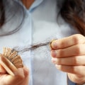 Finasteride: An Overview of Hair Loss Treatment