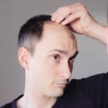 Lifestyle Changes to Prevent Male Pattern Baldness