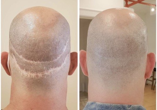 Exploring Scalp Camouflage Techniques for Hair Loss Solutions