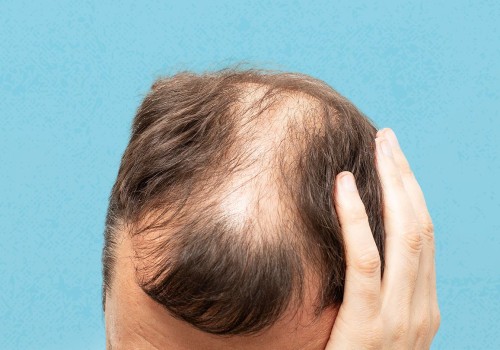 Hormonal Changes and Female Hair Loss: Causes and Risk Factors