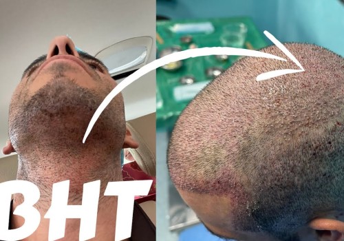 Everything You Need to Know About Hair Transplants
