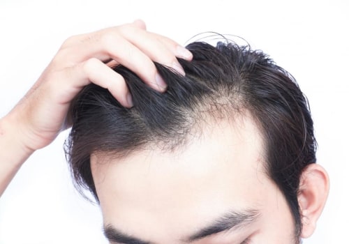 Vitamin D for Hair Growth