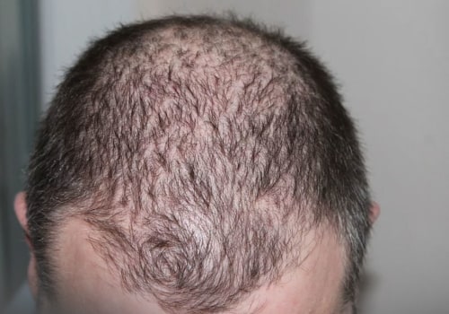 Iron-Deficiency Anemia and Hair Loss: A Comprehensive Overview