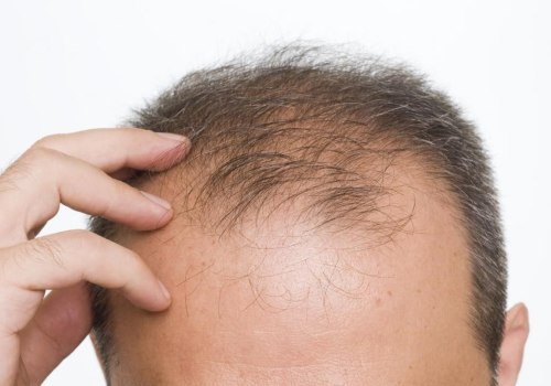 The Link Between Smoking and Hair Loss