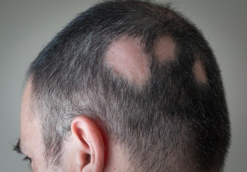 Alopecia: Causes, Symptoms, and Treatment