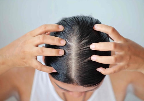 Understanding Hormonal Imbalances and Hair Loss