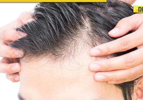 Male Pattern Baldness: Causes, Symptoms, and Treatments
