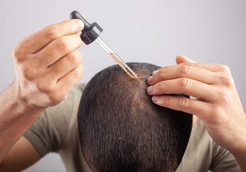Everything You Need to Know About Minoxidil