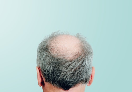 Hereditary Hair Loss: Exploring the Causes, Symptoms, and Treatment Options