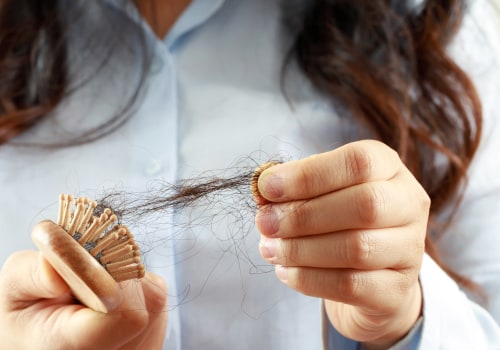 Finasteride: An Overview of Hair Loss Treatment