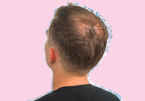 Diagnosing Male Pattern Baldness