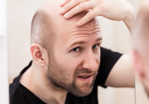 Genetics and Male Pattern Baldness: Causes and Risk Factors Explained