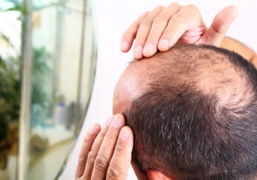 Lifestyle Factors and Male Pattern Baldness